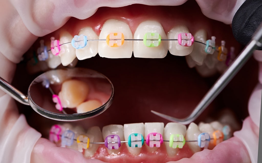 Impact Orthodontics: Leading Orthodontic Care in Calgary, Specializing in Braces and Invisalign Treatments